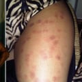 Can Laser Hair Removal Cause Burns? - An Expert's Perspective