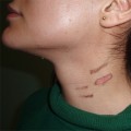 Potential Complications of Laser Hair Removal: What You Need to Know