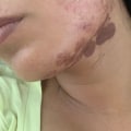 What Kind of Burns Can You Get from Laser Hair Removal Treatment?