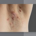 Can Laser Hair Removal Cause Scarring? - A Comprehensive Guide