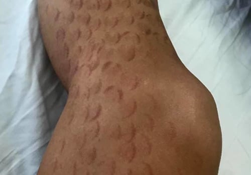What Does a Laser Hair Removal Burn Look Like? - A Comprehensive Guide