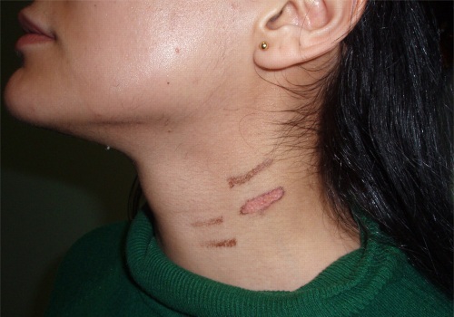 Potential Complications of Laser Hair Removal: What You Need to Know