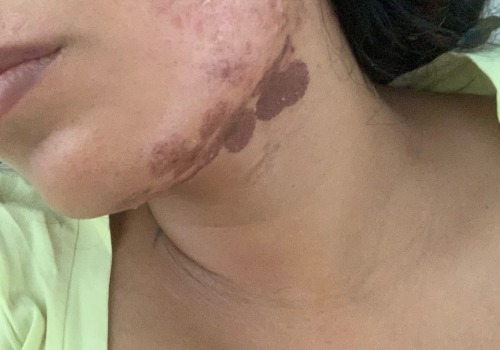 What Kind of Burns Can You Get from Laser Hair Removal Treatment?