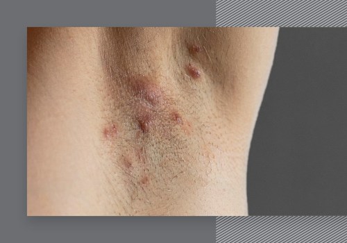 Can Laser Hair Removal Cause Infection? - An Expert's Perspective