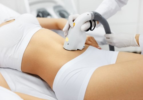 The Pros and Cons of Laser Hair Removal