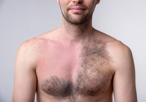 The Long-Term Effects of Laser Hair Removal: What You Need to Know
